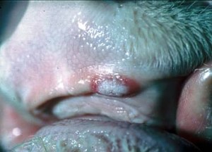 gjeth stomatitis papulosa